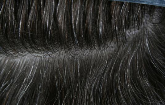 Hair Transplant&nbsp;Trichophytic Donor Scars